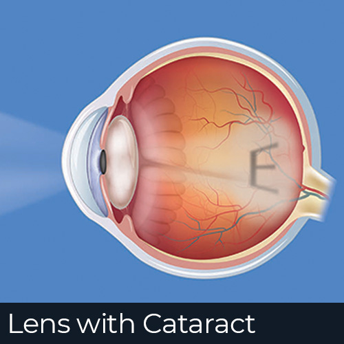Eye With a Cataract