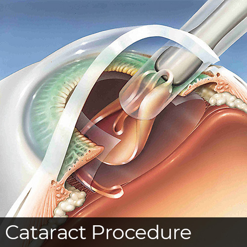 Placing a New Lens Into an Eye