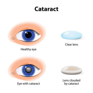 Cataract Diagram