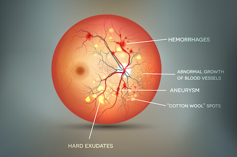 Medical illustration of diabetic retinopathy