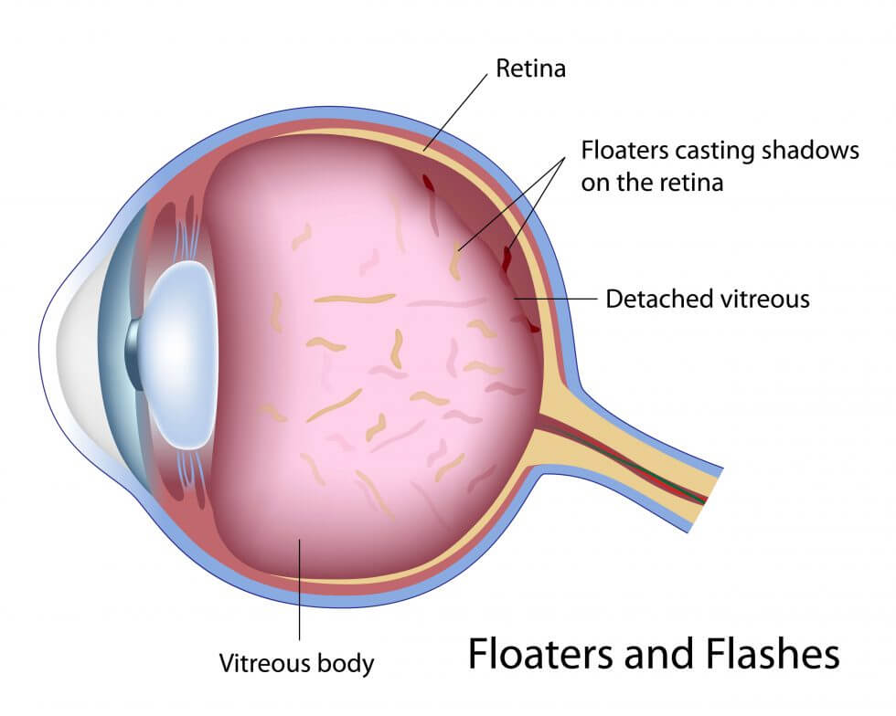 Floaters and Flashes Diagaram