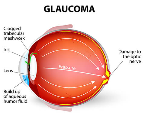 Glaucoma diagram