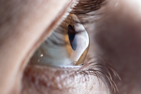 Close up view of a cornea with Keratoconus