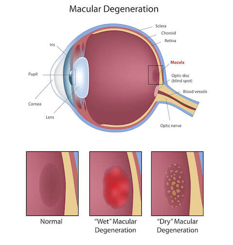 Macular Degeneration Medical Illustration